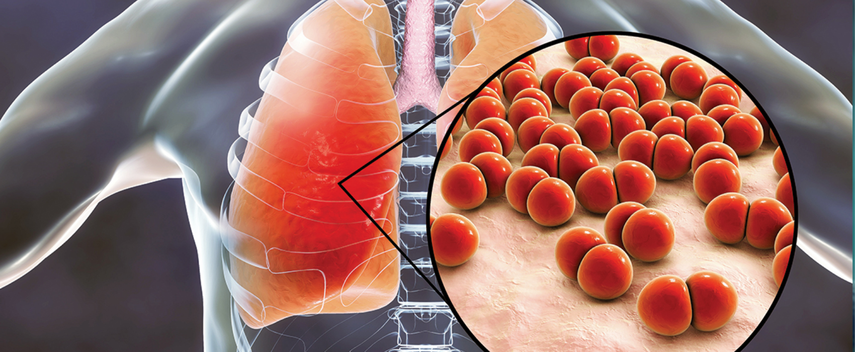 Vacunación Noticias  Enfermedad neumocócica y qué hacer contra ella