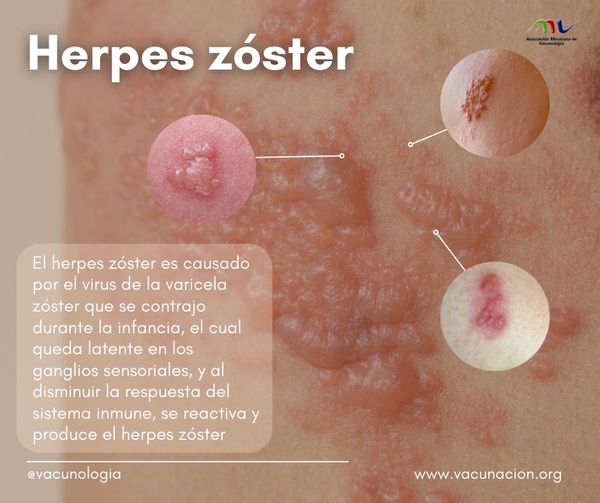 Herpes Zóster: Prevención y Protección mediante Vacunas